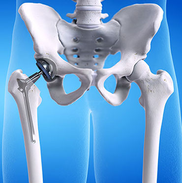 Total Hip Replacement