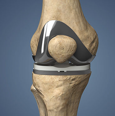 Total Knee Replacement2