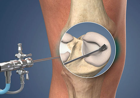 Knee Arthroscopy