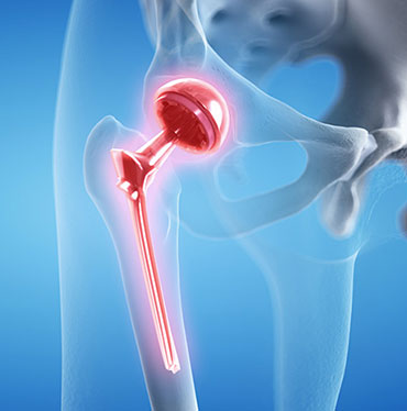 Revision Hip Replacement2