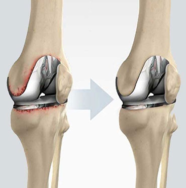 Revision Knee Replacement2