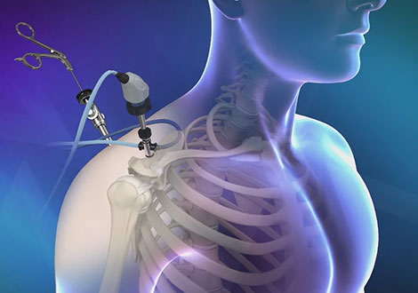 Shoulder Arthroscopy